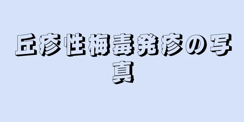丘疹性梅毒発疹の写真
